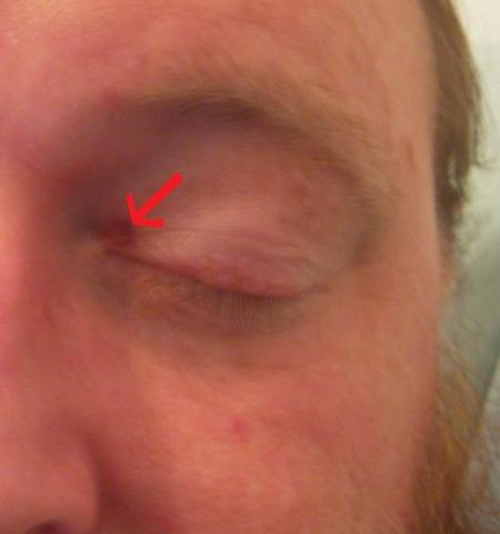 blackeye blackeye