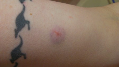 bruise